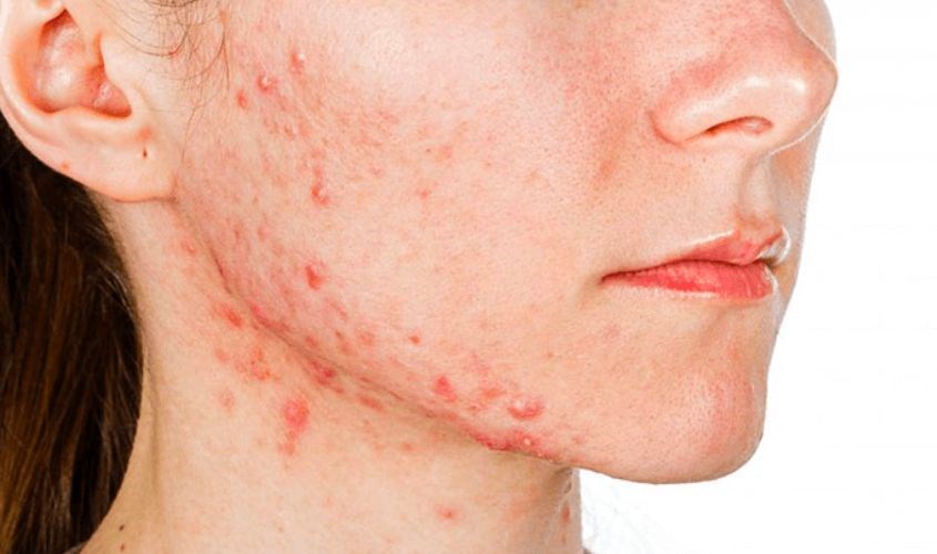 Mẹ bầu hay gặp phải tình trạng mụn ở má và cằm