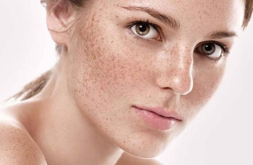 Các vết nám cũng khá phổ biến khi chị em mang thai