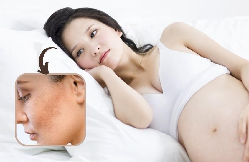 Giai đoạn mang thai da mẹ thường hay gặp tình trạng sạm, nám, tàn nhang