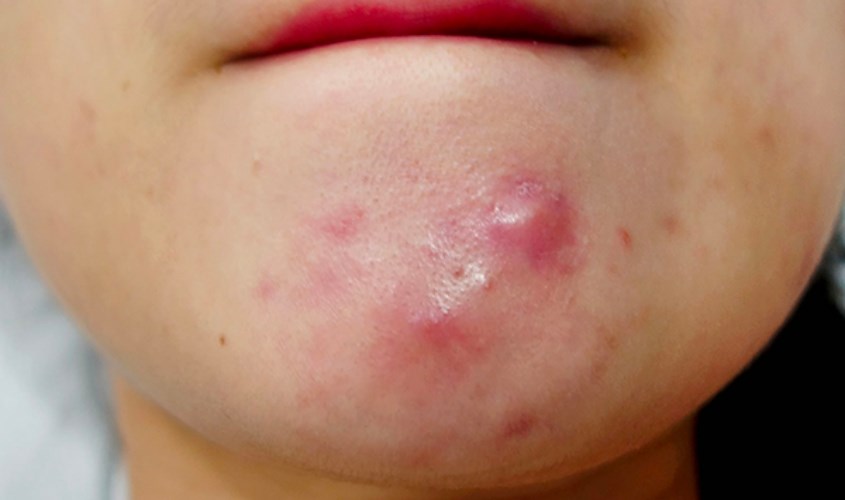 Mụn viêm không nhân càng lớn sẽ càng sưng đỏ và gây đau nhức