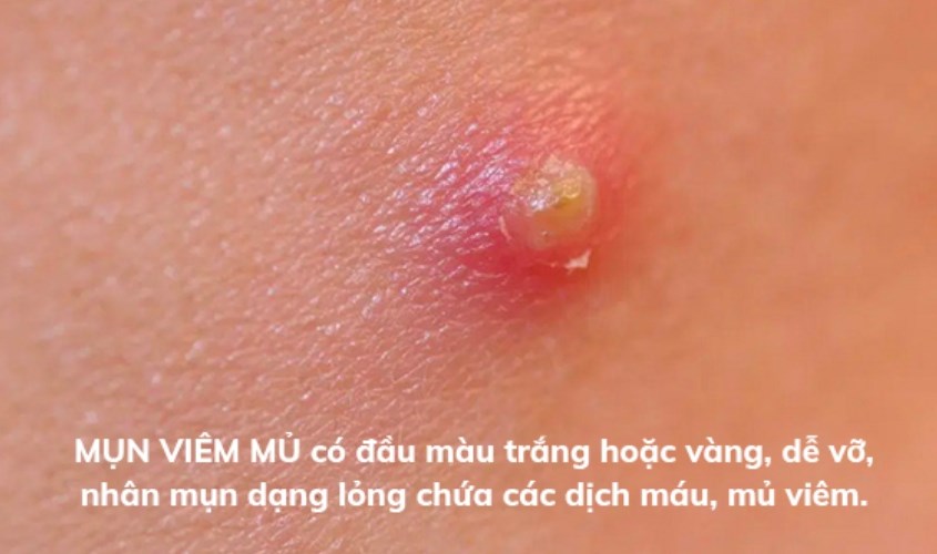 Mụn viêm mủ có lớp da bên ngoài khá mỏng, gây đau và dễ vỡ