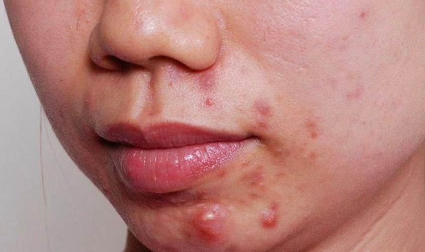 Mụn viêm bọc là kết quả của quá trình viêm nhiễm trên bề mặt da