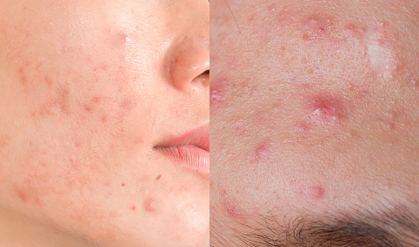 Đây là loại mụn viêm nhiễm nặng gây sưng tấy và đau nhức