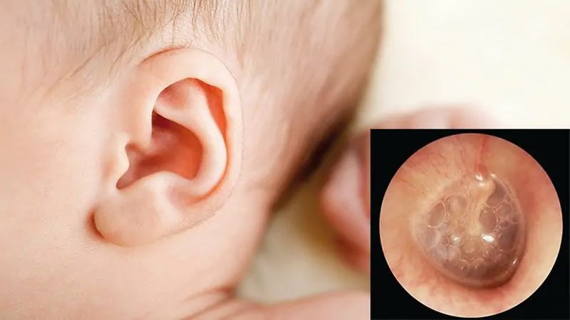 Ráy tai hay các dịch lỏng và bụi bẩn có thể làm tắc nghẽn ống tai