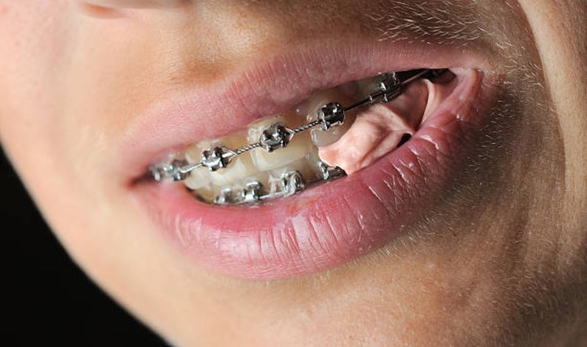 Niềng răng không nên nhai kẹo cao su