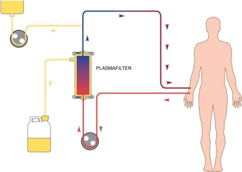 Dùng phương pháp plasmapheresis cho trẻ. Nguồn từ childkidneycare