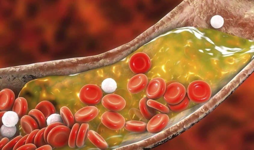 Các mảng xơ vữa có thể gây hẹp hay tắc mạch máu