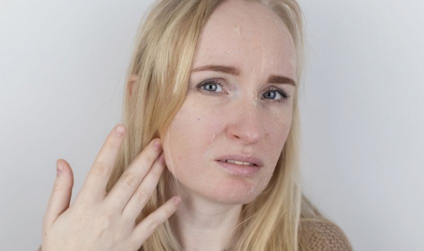 Tác dụng phụ khi sử dụng benzoyl peroxide là da khô, đỏ da