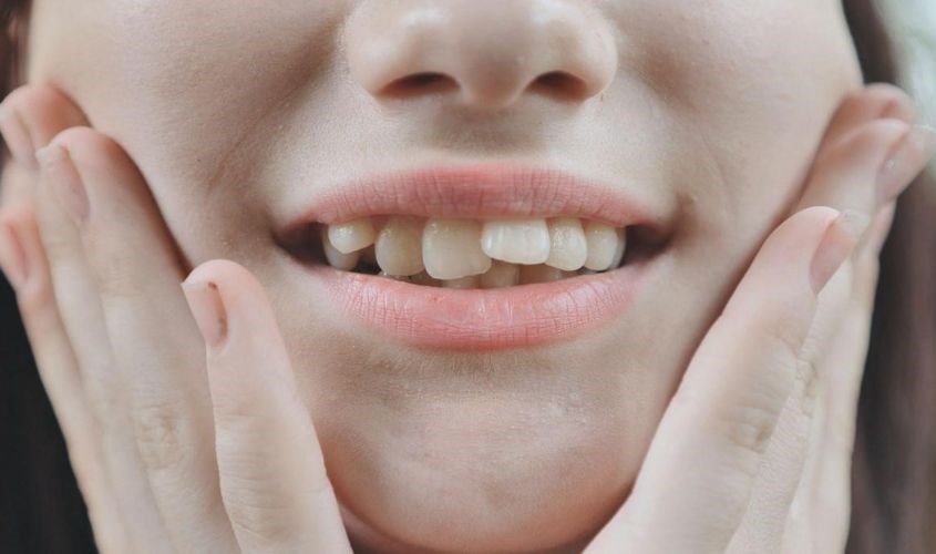 Thiếu vitamin D khiến răng mọc không đều