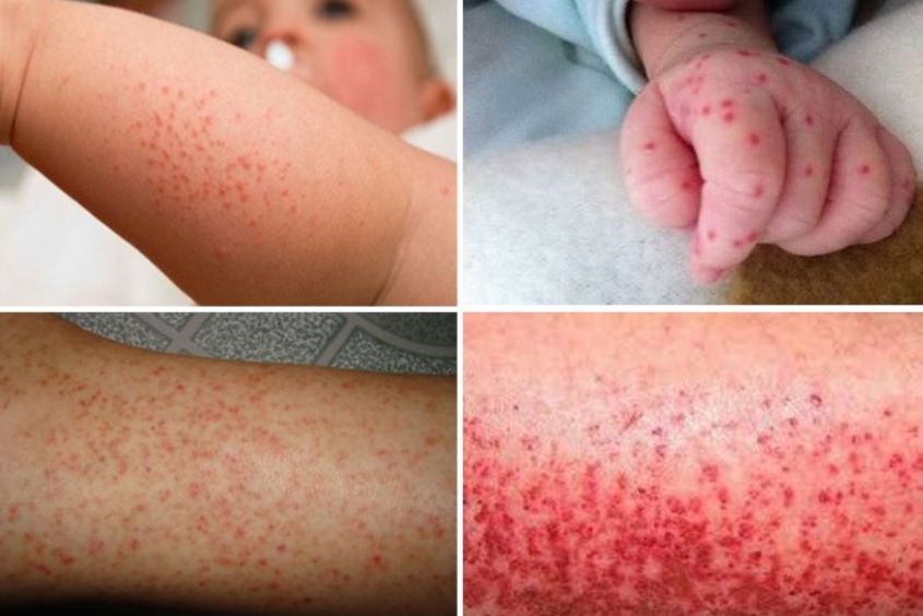 Triệu chứng sốt xuất huyết ở trẻ phổ biến nhất