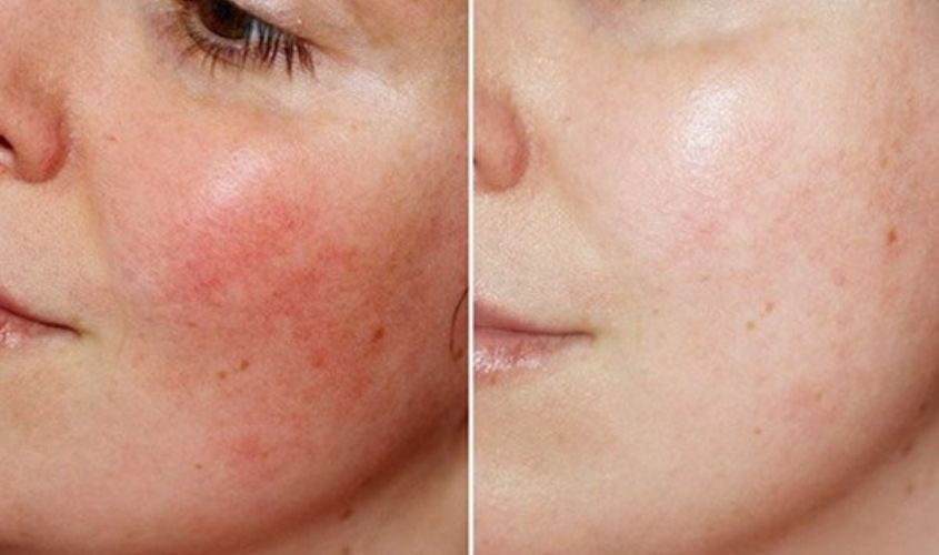 Có tác dụng làm dịu da Có tác dụng làm dịu da