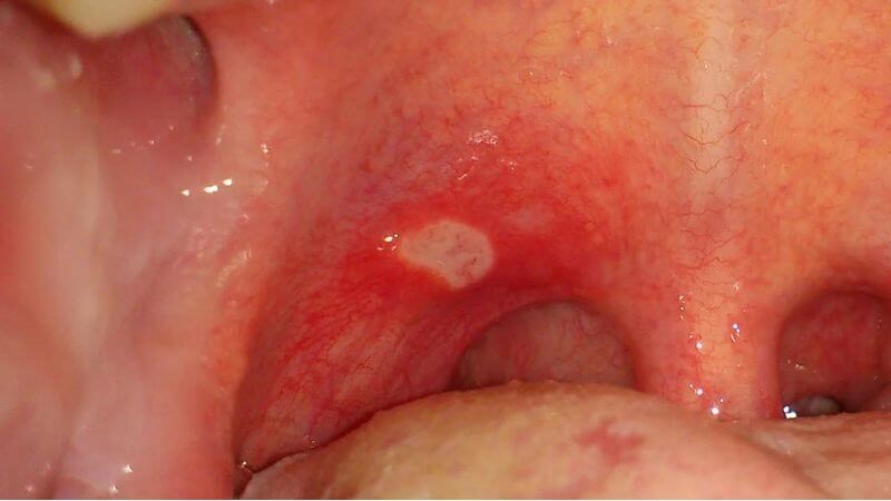 Vết loét miệng gây đau họng 1 bên