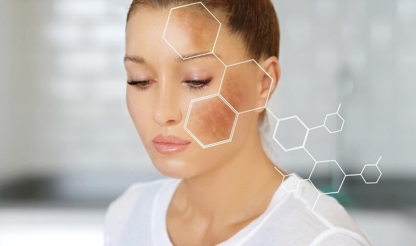 Sữa ong chúa giúp cải thiện nám, tàn nhang giúp trẻ hoá làn da