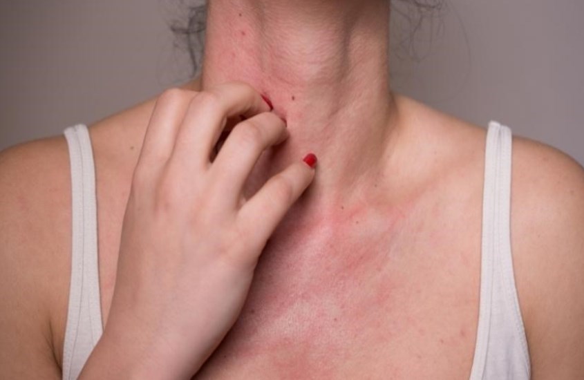 Nên ngưng sử dụng sữa ong chúa nếu bị kích ứng, nổi mẩn đỏ trên da