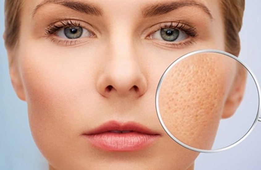 Sữa ong chúa giúp se khít lỗ chân lông