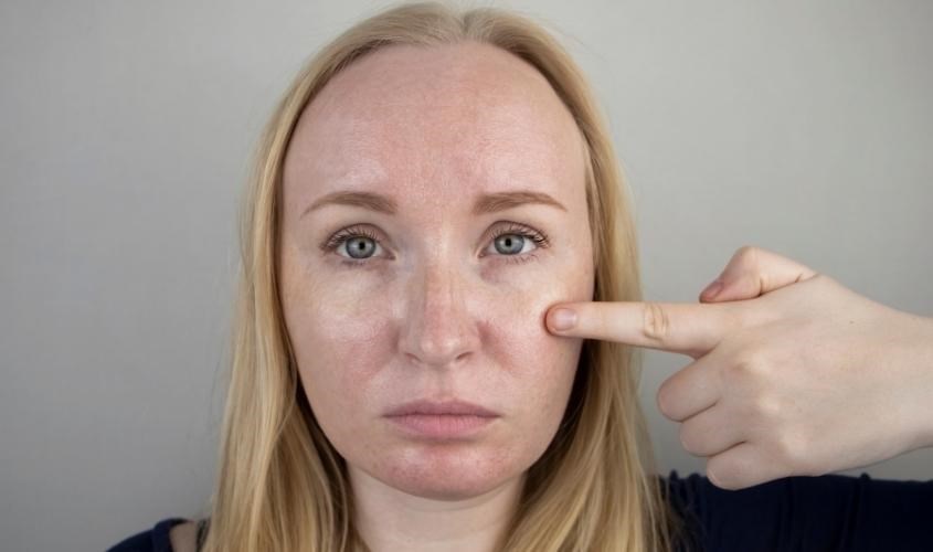 Cách chăm sóc da dầu nhờn bằng sữa ong chúa