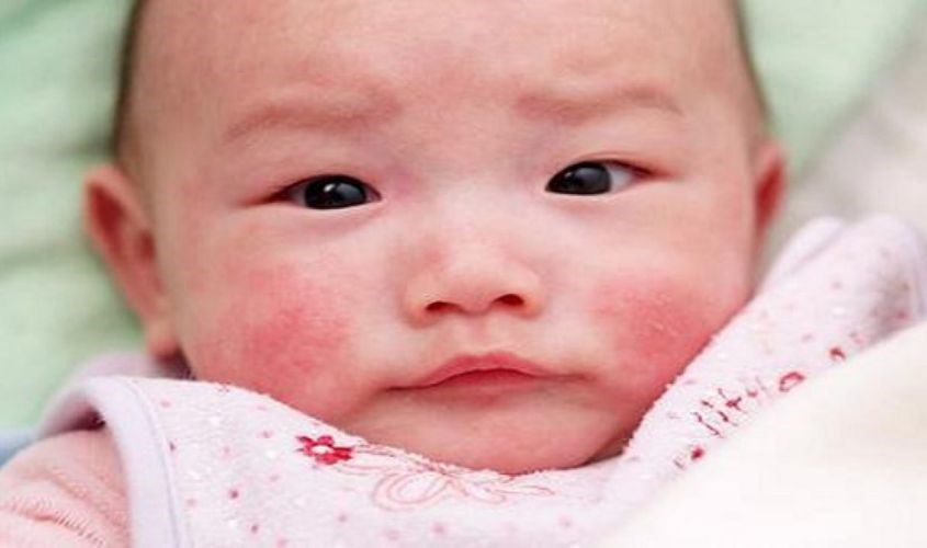 Có thể gây ra dị ứng ở một số trẻ