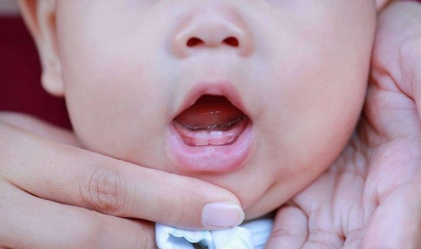 Bố mẹ cần quan tâm đến tình trạng sâu răng của trẻ