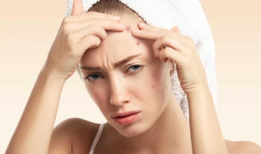 Không nên sử dụng mặt nạ giấy sau khi nặn mụn