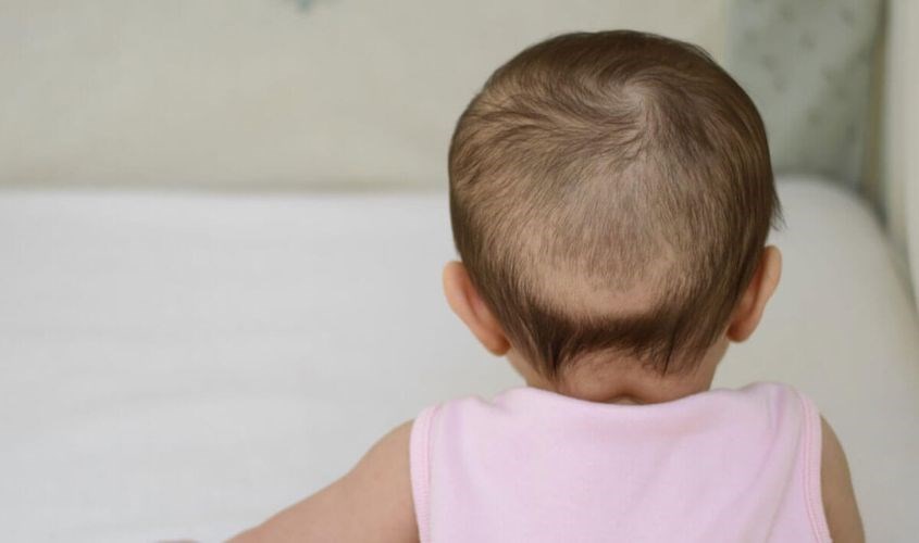 Việc thiếu Canxi không làm cho trẻ rụng tóc vành khăn