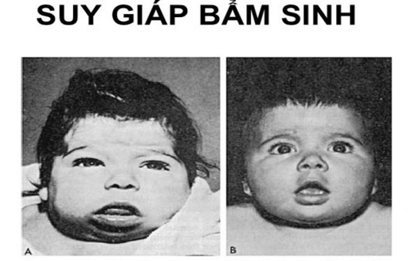 Suy giáp bẩm sinh (CH) ở trẻ