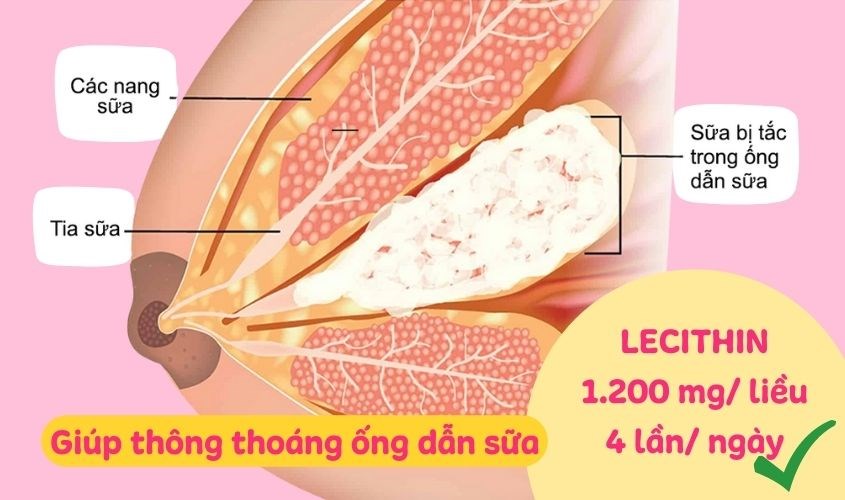 Sử dụng Lecithin mỗi ngày 4 lần với hàm lượng 1.200 mg/ liều giúp thông ống dẫn sữa