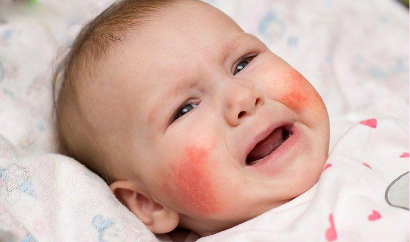 Tại sao nên dùng kem dưỡng ẩm cho trẻ sơ sinh?