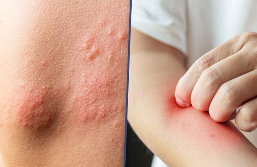 Prebiotics có khả năng làm giảm sự phát triển của viêm phong da ở trẻ sơ sinh.