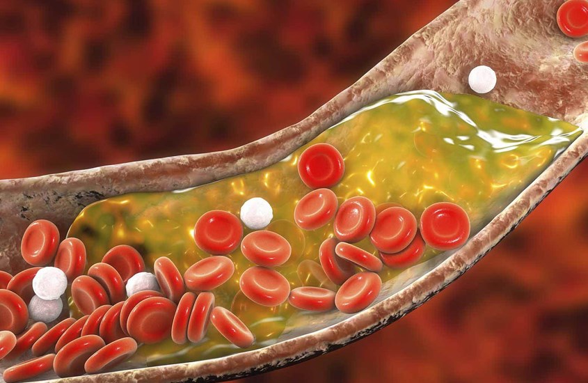 Giảm cholesterol trong máu