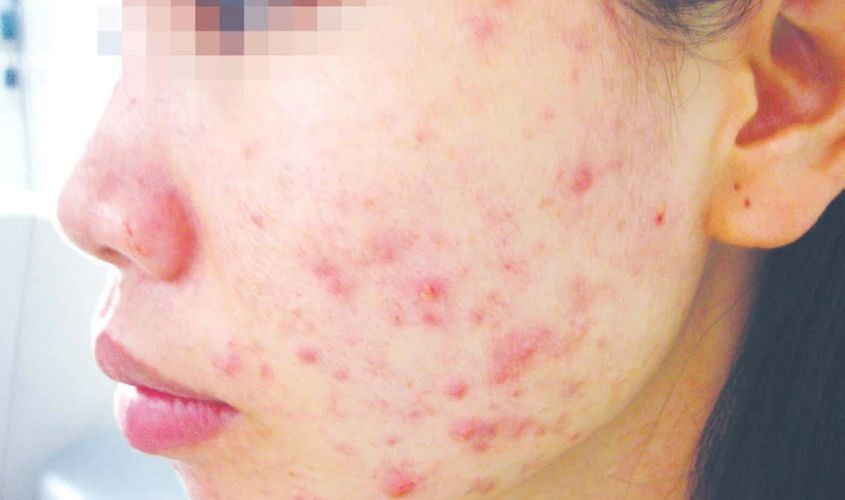 Tác hại của việc dùng kem dưỡng B5 hàng giả