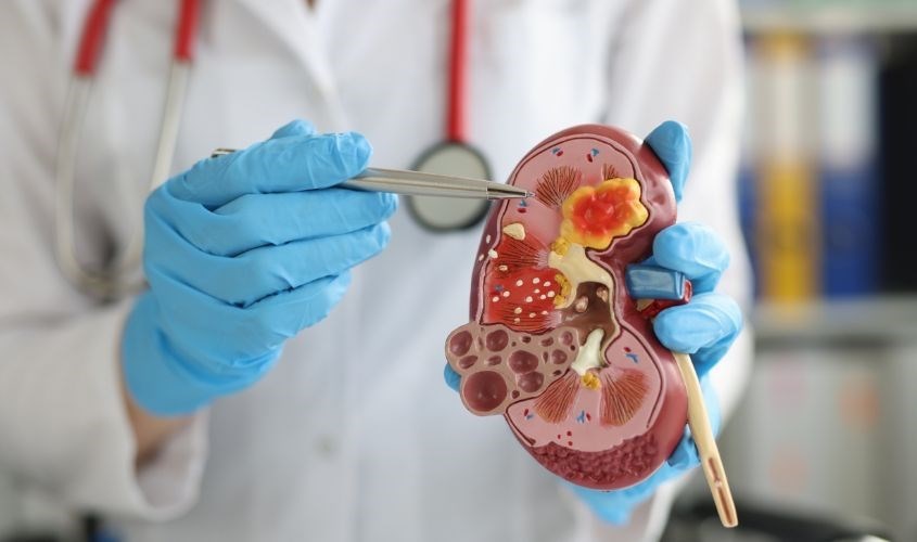 Người bị sỏi thận nên cân nhắc khi dùng sữa đậu nành