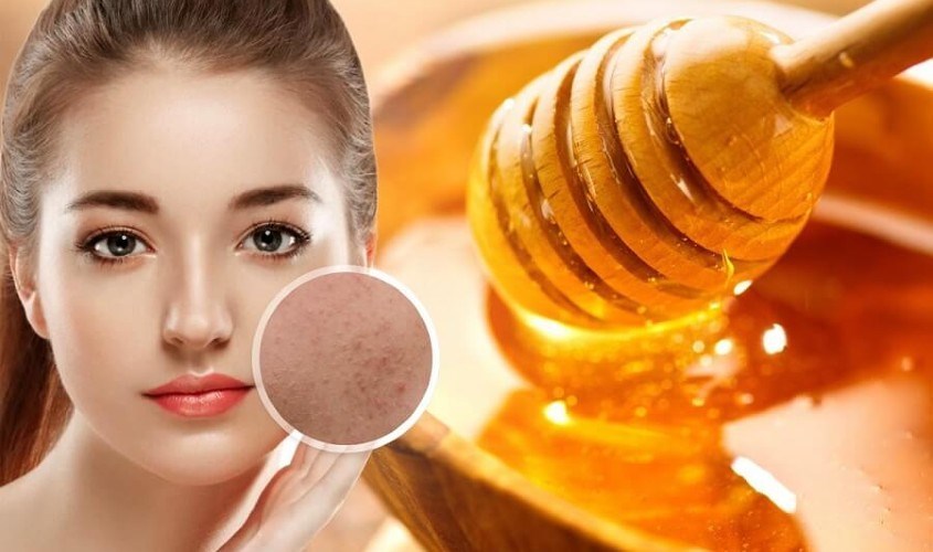 Sữa chua kết hợp cùng mật ong rất tốt cho da và quá trình trị mụn trứng cá