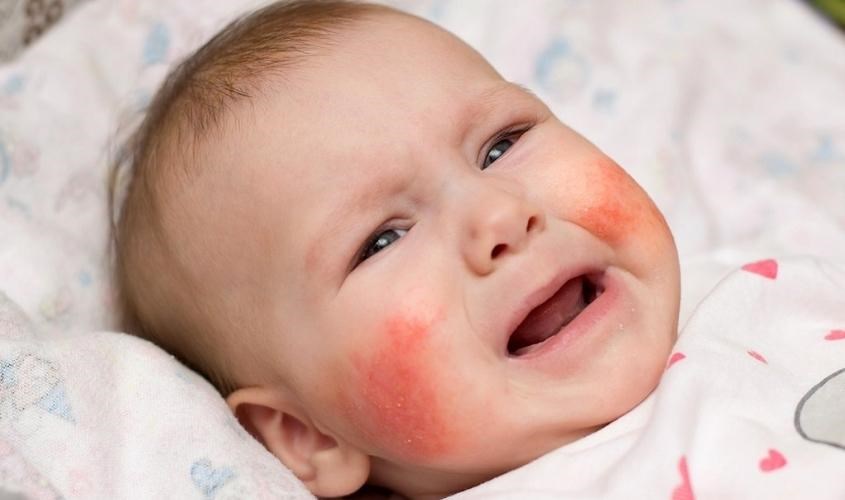 Vitamin C làm giảm nguy cơ bé mắc các bệnh dị ứng