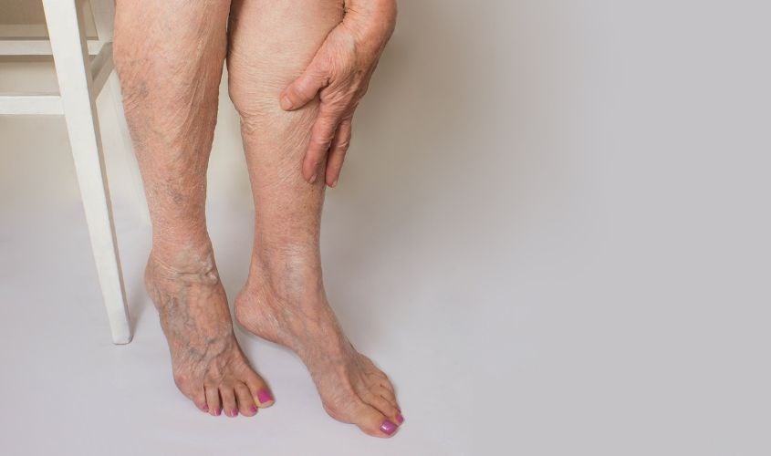 Mẹ bầu có thể ngăn ngừa suy giãn tĩnh mạch khi dùng vitamin C Mẹ bầu có thể ngăn ngừa suy giãn tĩnh mạch khi dùng vitamin C