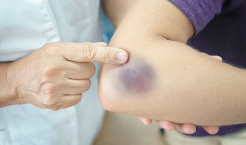 Vitamin C giúp phục hồi vết bầm tím nhanh chóng Vitamin C giúp phục hồi vết bầm tím nhanh chóng