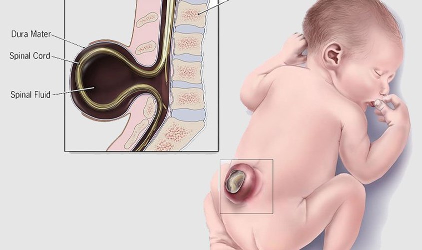 Axit folic giúp ngăn ngừa dị tật ống thần kinh ở trẻ