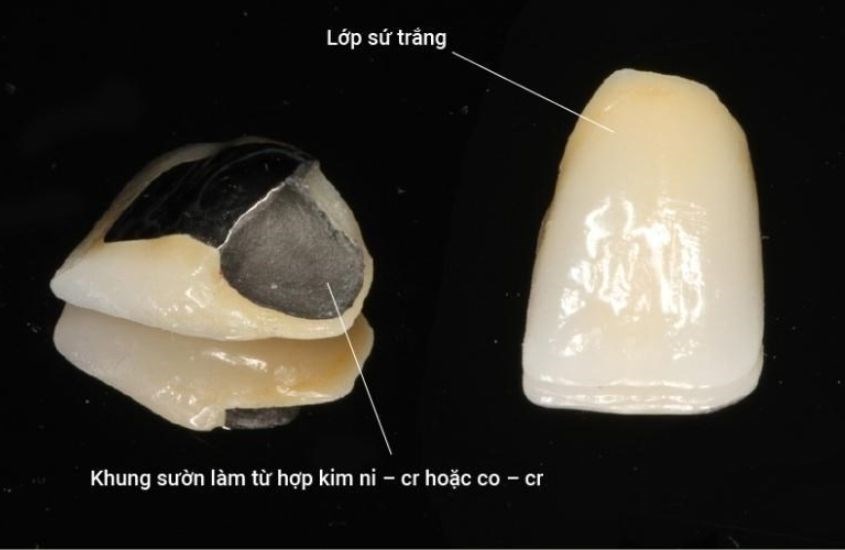 Răng sứ kim loại