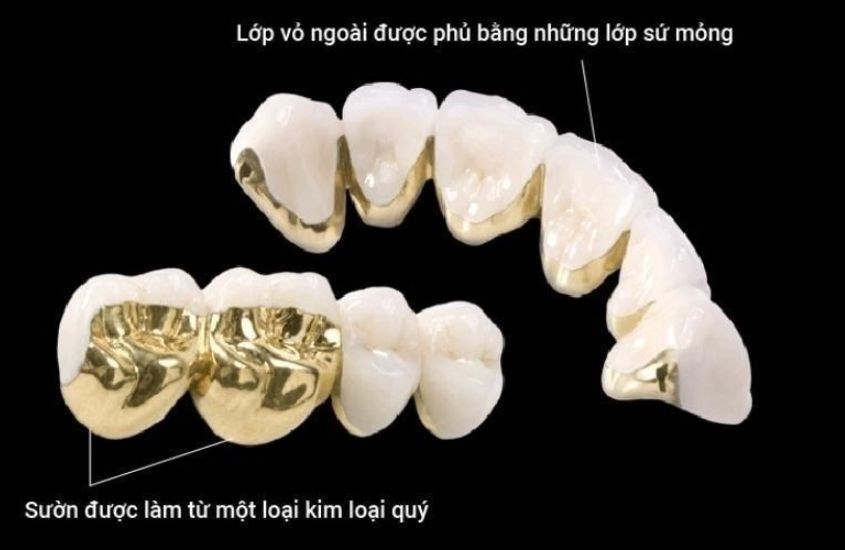 Răng sứ kim loại quý