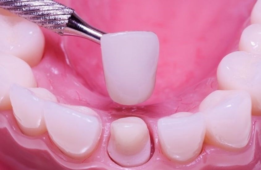  Đến các cơ sở nha khoa uy tín để có kỹ thuật trồng răng tốt