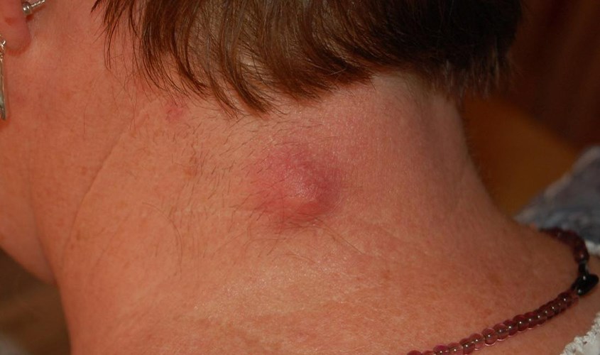 Chè vằng hỗ trợ trị mụn nhọt hiệu quả Chè vằng hỗ trợ trị mụn nhọt hiệu quả