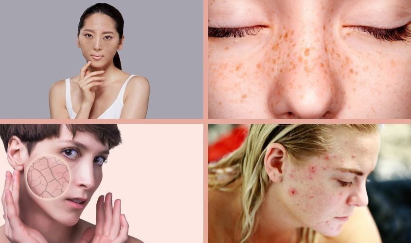 Các vấn đề về da thường gặp sau sinh như nám, tàn nhang, nứt nẻ, mụn đỏ,...