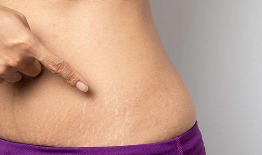 Rạn da là tình trạng phổ biến sau khi sinh