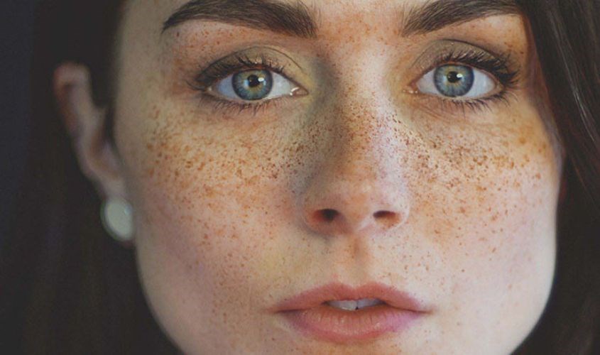 Nguyên nhân gây ra tình trạng nám da, tàn nhang là do thay đổi nội tiết tố