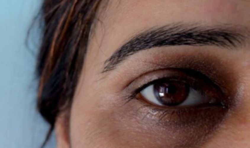 Quầng thâm, bọng mắt do thay đổi nội tiết tố và thiếu ngủ gây ra