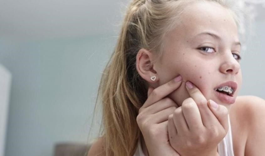 Sữa non Goodhealth giúp giảm mụn trứng cá ở thanh thiếu niên