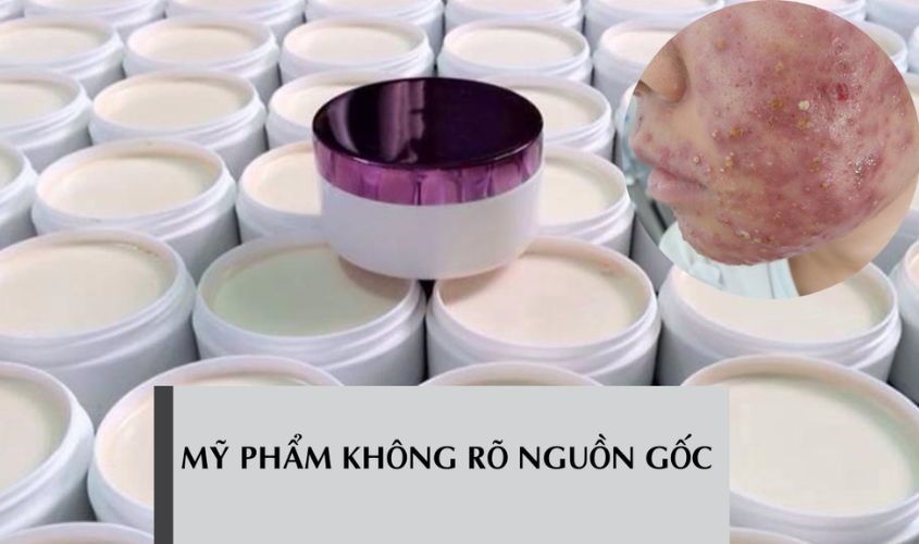 Mỹ phẩm không rõ nguồn gốc gây ra hậu quả khó lường