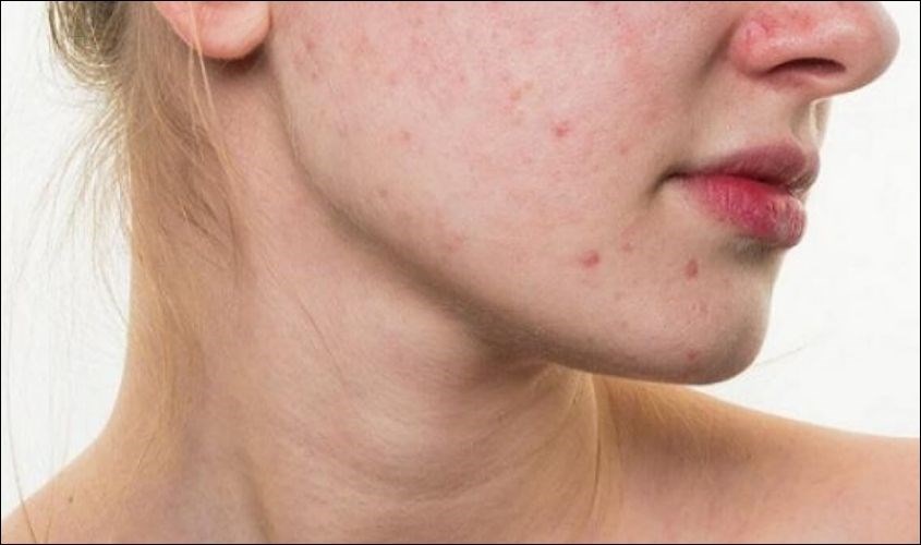 Nổi mụn trứng cá ở trên mặt
