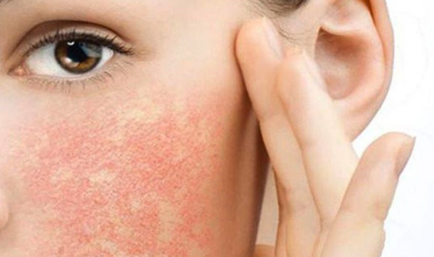 Làn da bị dị ứng mỹ phẩm