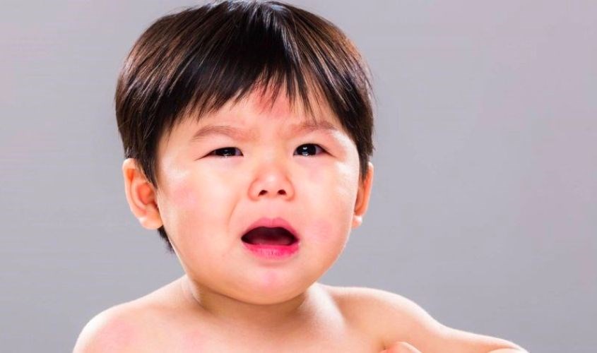 Bé bị dị ứng đạm sữa bò