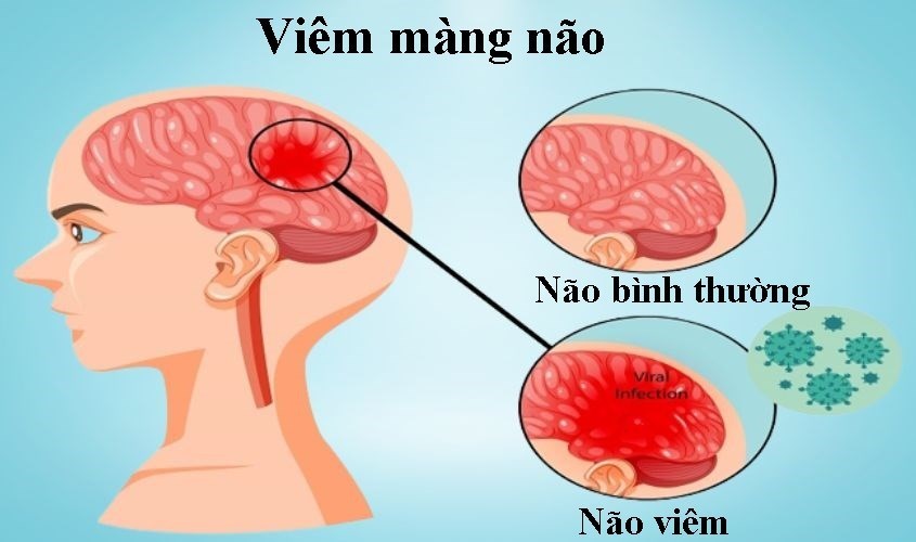 Viêm màng não ở trẻ sơ sinh là gì